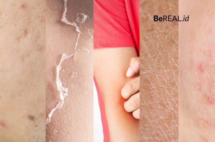 BEREAL.ID 5 Efek Samping Cream Wardah Pada Kulit yang Wajib Kamu Tahu